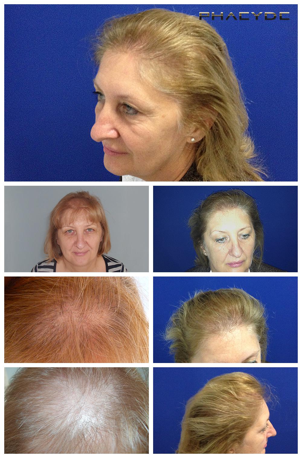 Restauration de cheveux pour femme