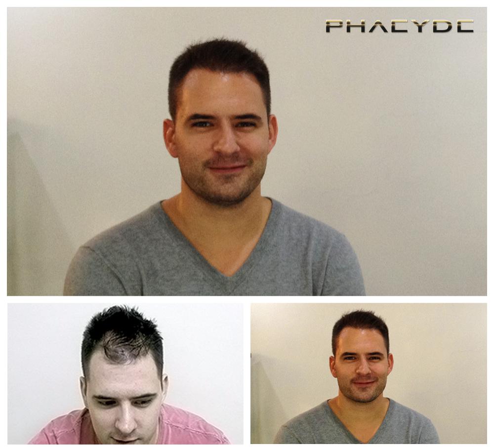 Transplantacija kose fue rezultati prije poslije fotografija andras somogyi - PHAEYDE Klinika