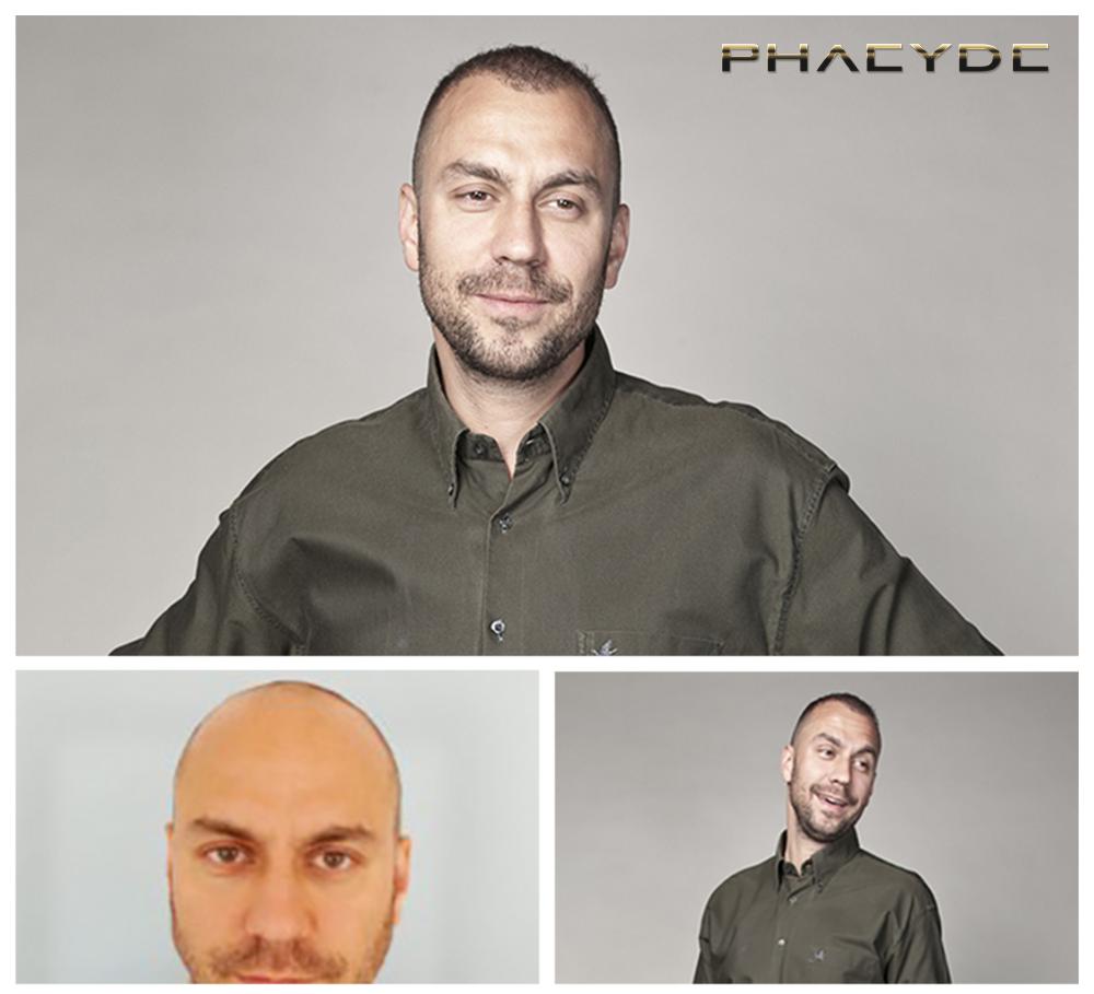 Transplantacija kose fue rezultati prije poslije fotografija attila csenki - PHAEYDE Klinika