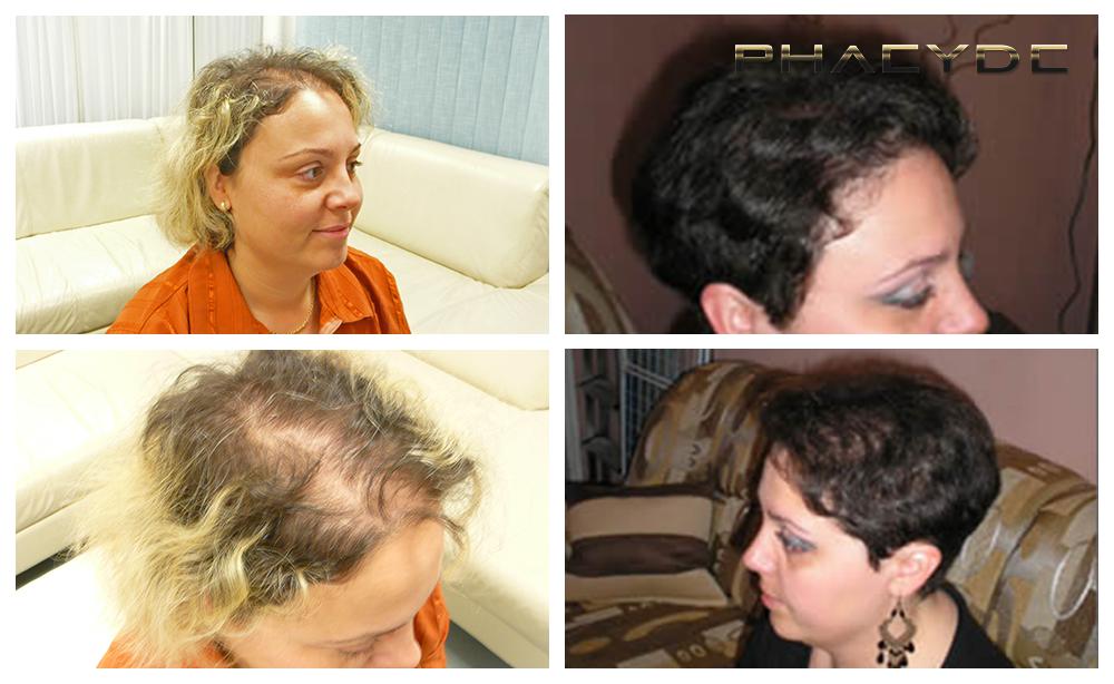 Transplantacija kose fue rezultati prije poslije fotografija christina torok woman - PHAEYDE Klinika