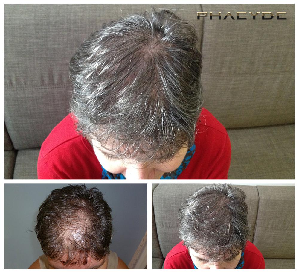Transplantacija kose fue rezultati prije poslije fotografija erika d - PHAEYDE Klinika