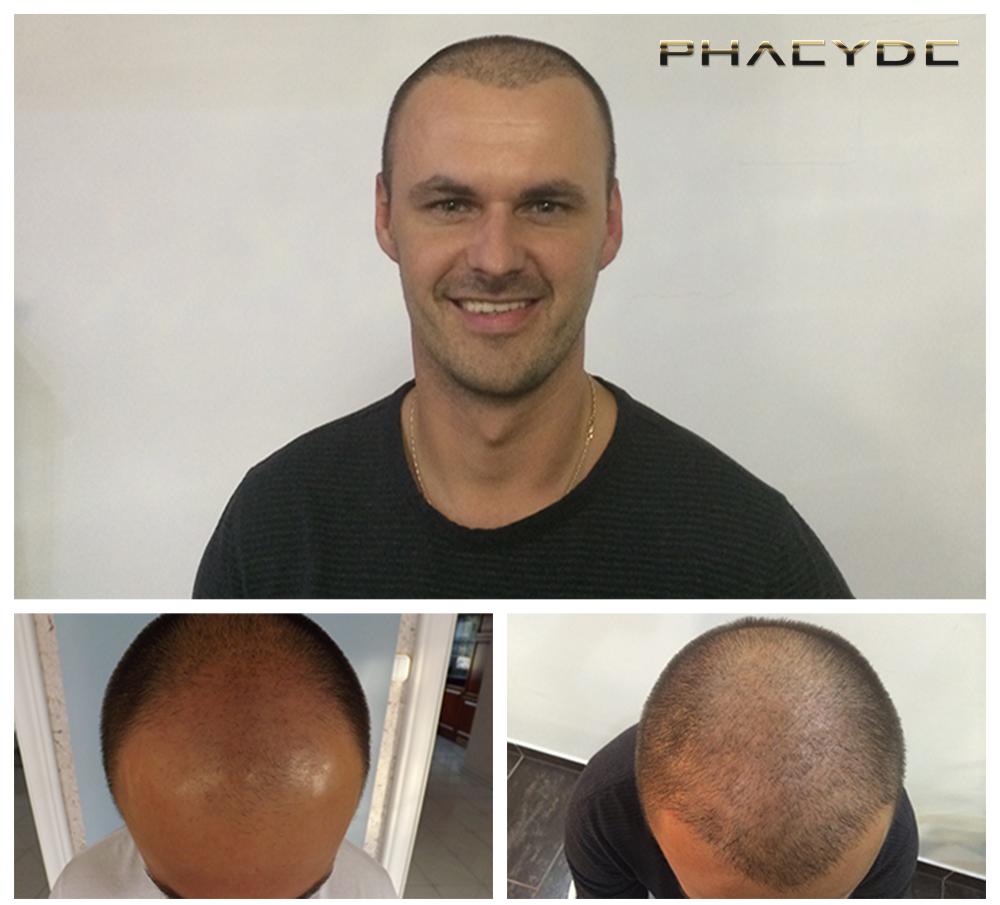 Transplantacija kose fue rezultati prije poslije fotografija leslie k - PHAEYDE Klinika