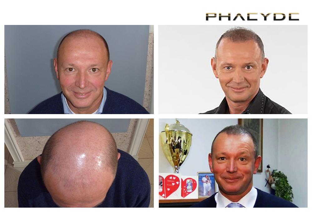 Transplantacija kose fue rezultati prije poslije fotografija pal gyorfi - PHAEYDE Klinika