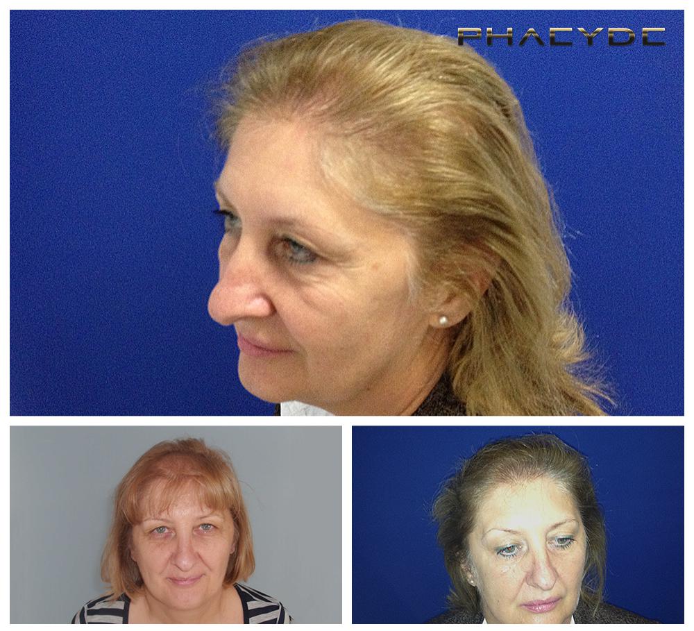 Transplantacija kose fue rezultati prije poslije fotografija susanne mikola - PHAEYDE Klinika