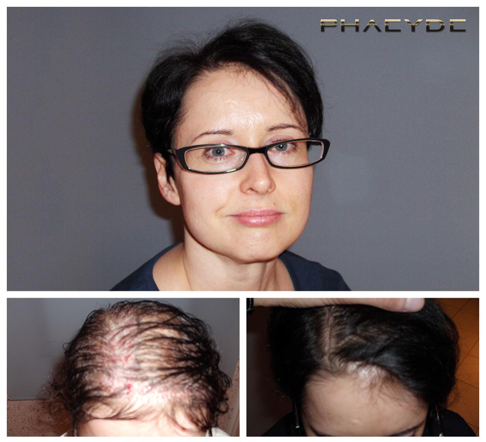 Transplantacija kose fue rezultati prije poslije fotografija susanne ujhegyi woman - PHAEYDE Klinika