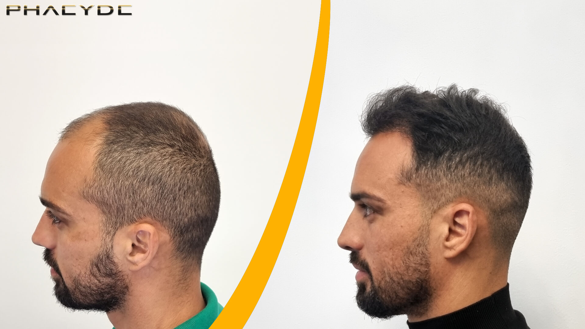 Transplantacija Kose - Prije & Poslije Rezultat