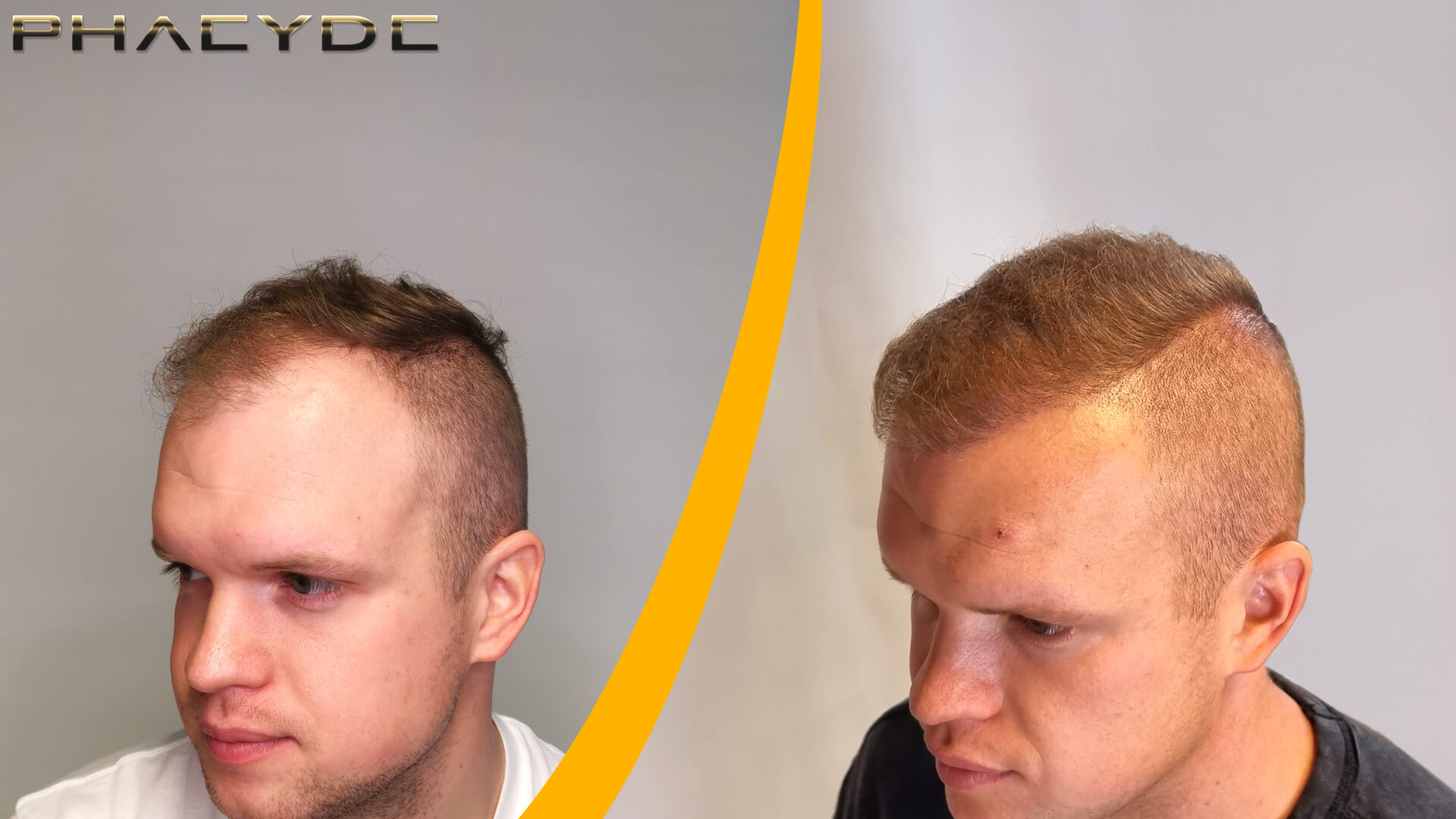Patrik: Prije-Nakon Presađivanja Kose