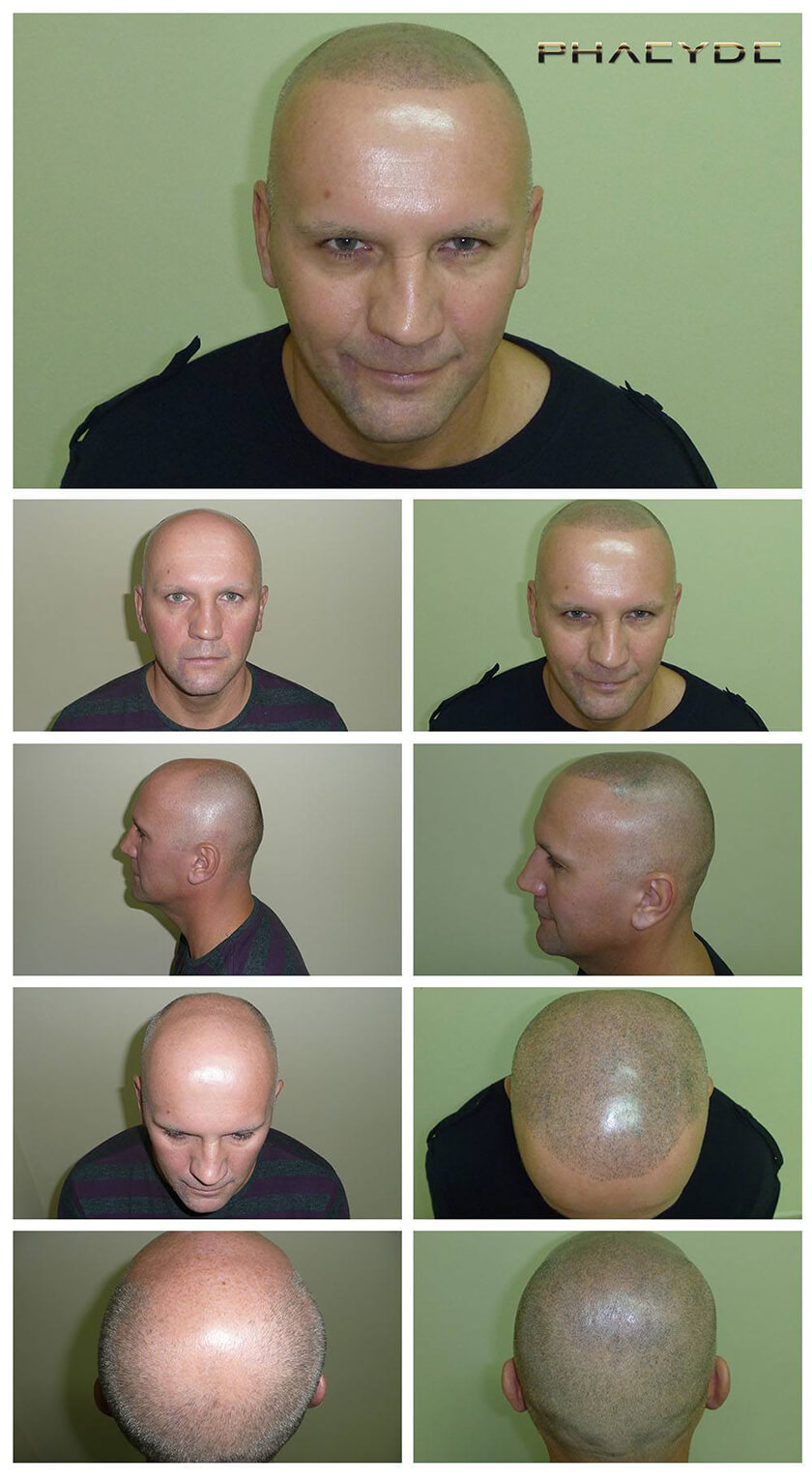 Before After Hair Pigmentation Photos at PHAEYDE Clinic