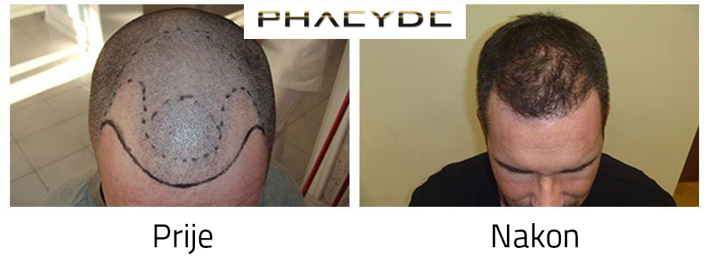 Трансплантация волос до и после. Миноксидил до и после лысина. Неудачная трансплантация волос. Месяц после пересадки волос. Пересадка волос через месяц.