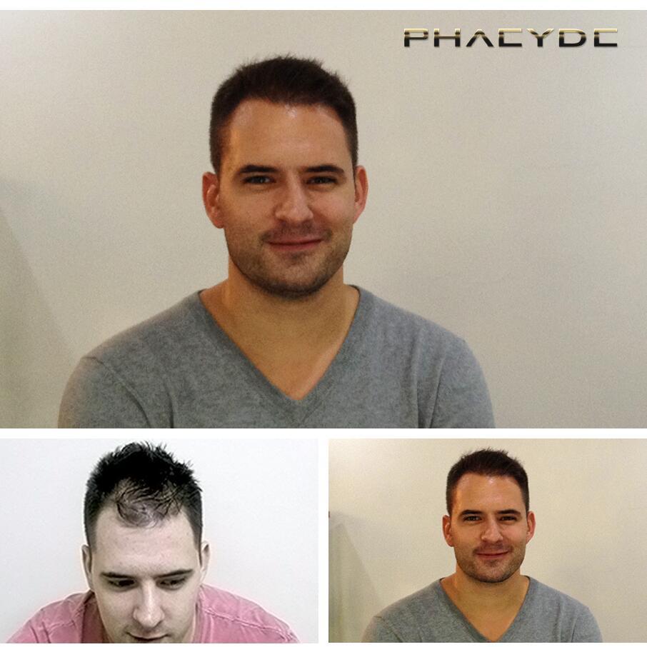 Haartransplantatie fue resultaten voor na fotos andras somogyi - PHAEYDE Kliniek