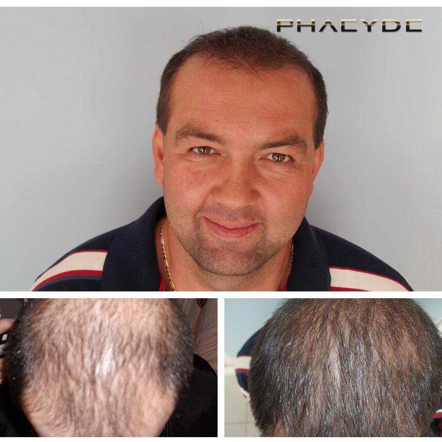 Haartransplantatie fue resultaten voor na fotos laszlo d - PHAEYDE Kliniek