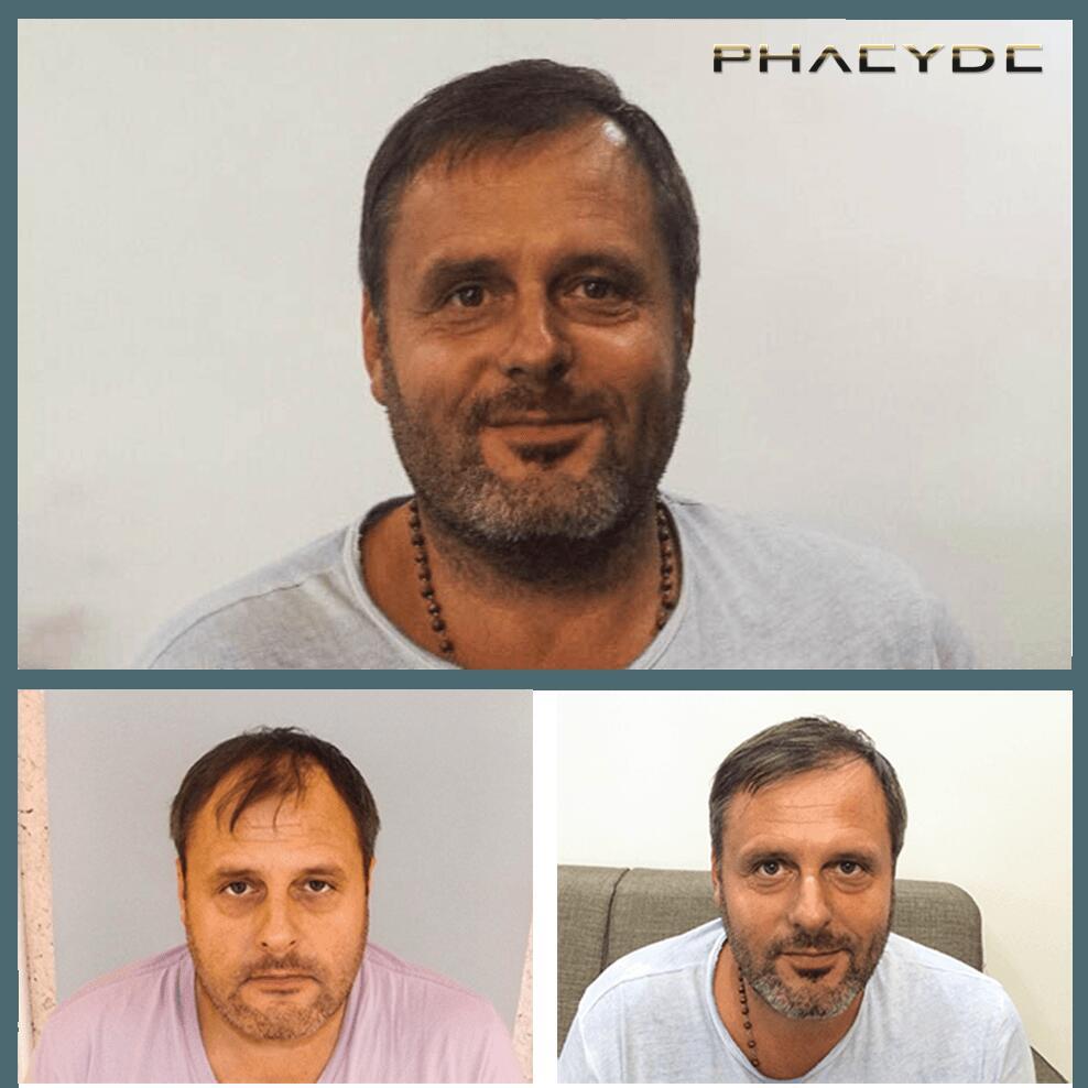 Haartransplantatie fue resultaten voor na fotos michael k - PHAEYDE Kliniek