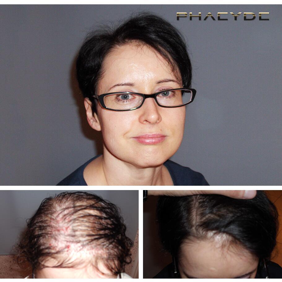 Haartransplantatie fue resultaten voor na fotos susanne ujhegyi woman - PHAEYDE Kliniek