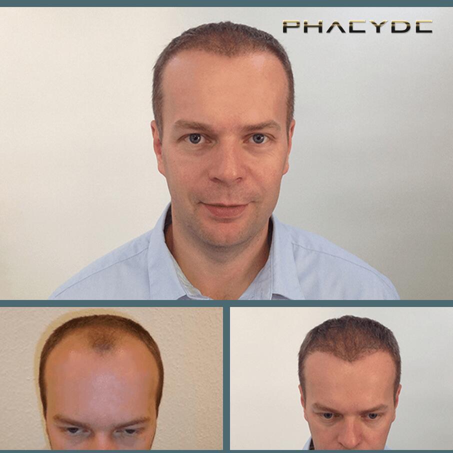 Haartransplantatie fue resultaten voor na fotos thomas lajtos - PHAEYDE Kliniek