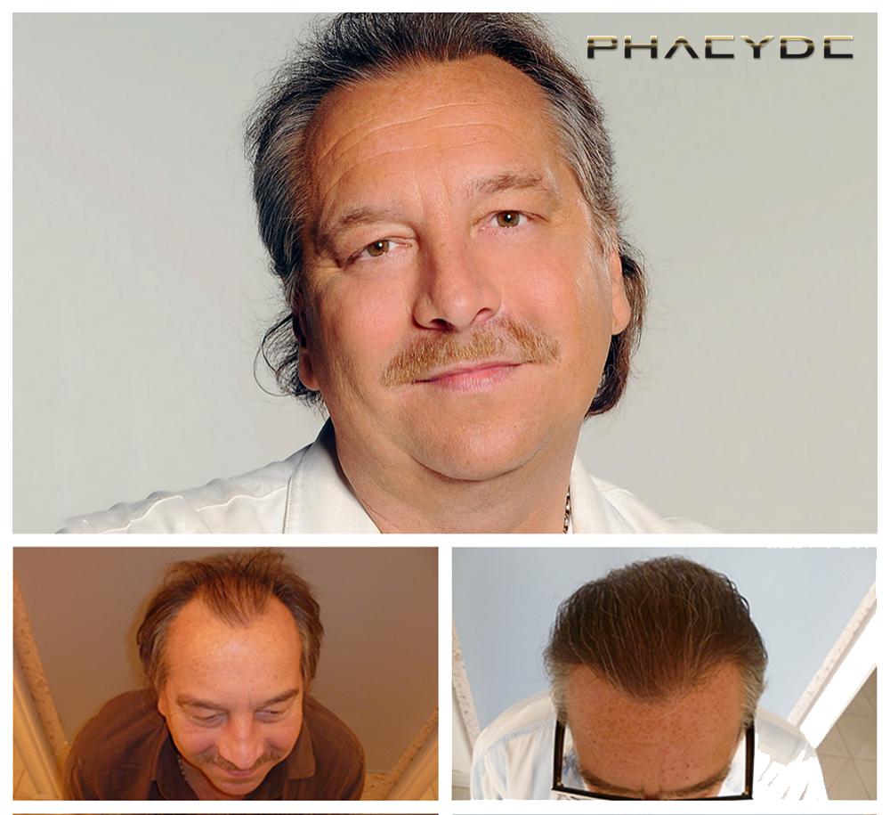 Transplantacija kose fue rezultati prije poslije fotografija imre bajor - PHAEYDE Klinika