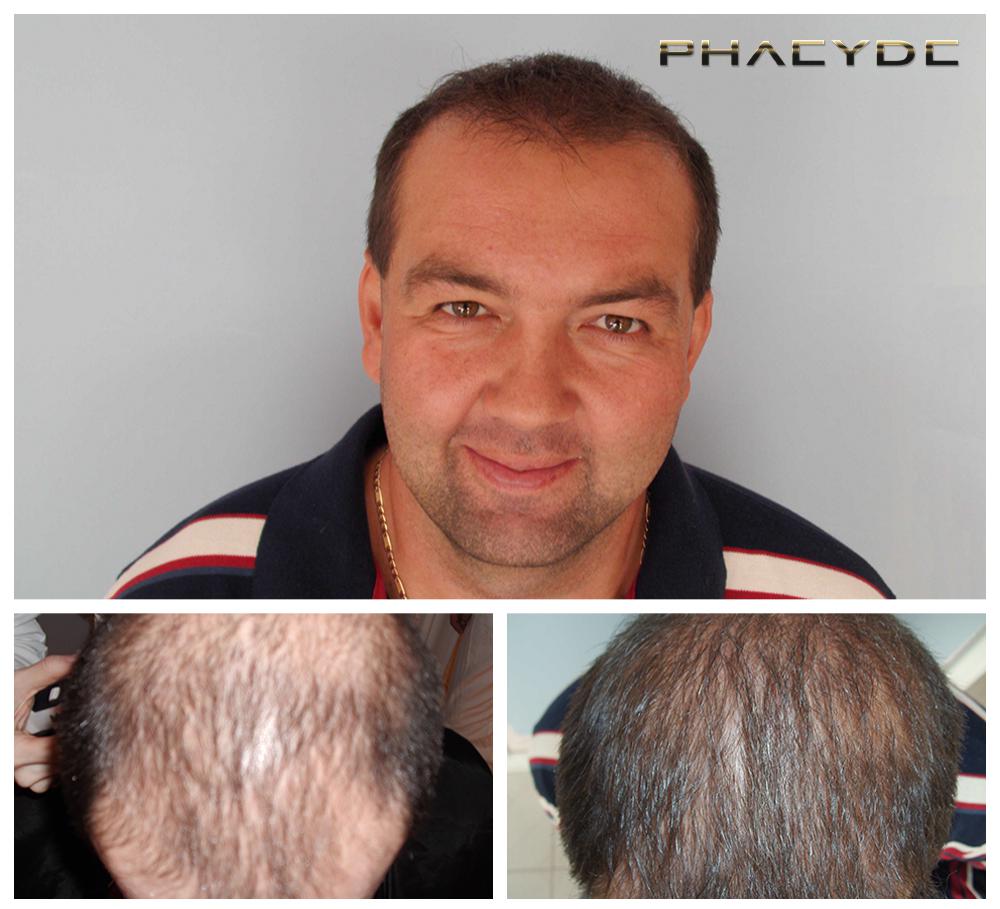 Transplantacija kose fue rezultati prije poslije fotografija laszlo d - PHAEYDE Klinika