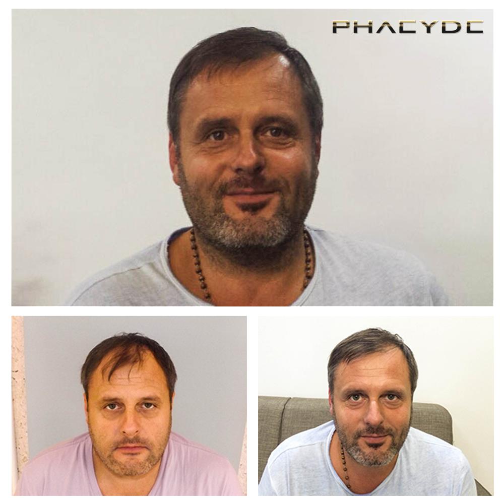 Transplantacija kose fue rezultati prije poslije fotografija michael k - PHAEYDE Klinika