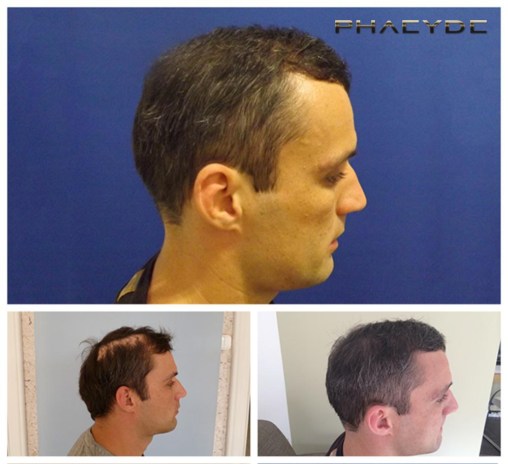 Transplantacija kose fue rezultati prije poslije fotografija peter p gallery - PHAEYDE Klinika