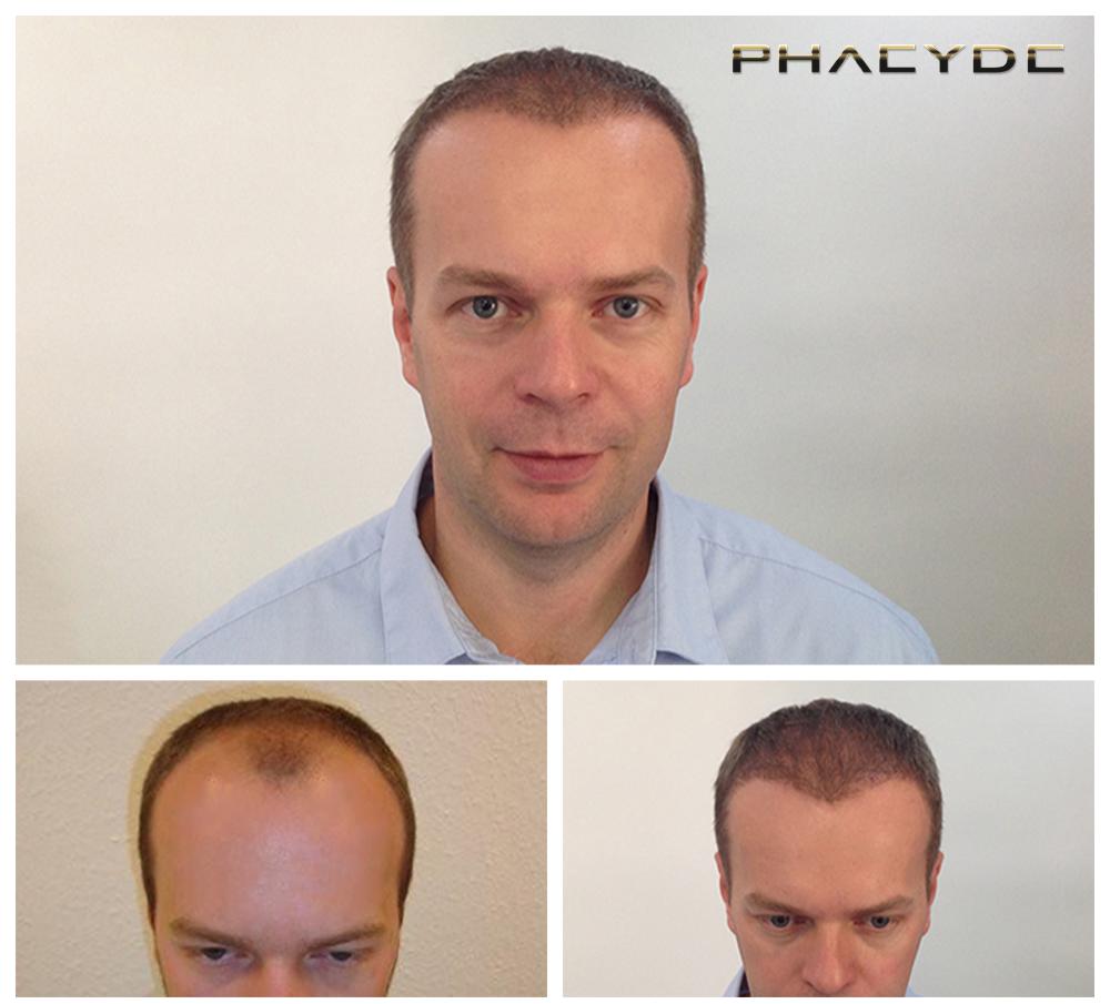 Transplantacija kose fue rezultati prije poslije fotografija thomas lajtos - PHAEYDE Klinika