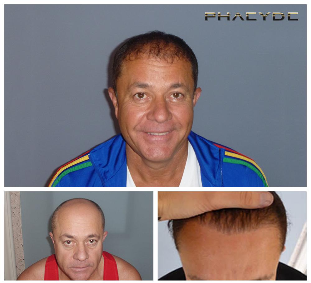 Transplantacija kose fue rezultati prije poslije fotografija zoltan cs - PHAEYDE Klinika