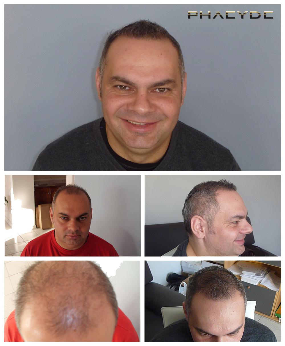 Transplantacija kose fue rezultati prije poslije fotografija zoltan lencse - PHAEYDE Klinika