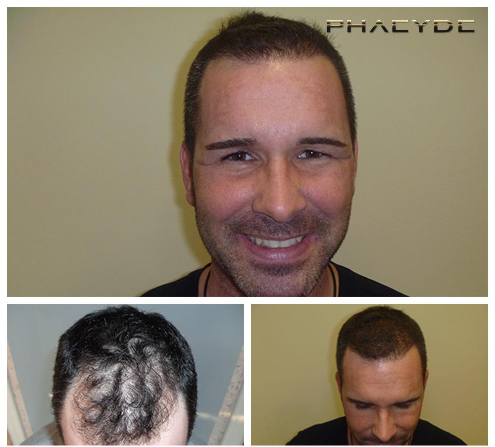 Transplantacija kose fue rezultati prije poslije fotografija zsolt vincze - PHAEYDE Klinika